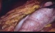 Corporocaudal pancreatectomy for Frantz tumor with Warshaw technique