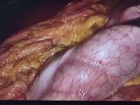 Corporocaudal pancreatectomy for Frantz tumor with Warshaw technique