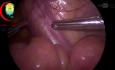 Neo-canal Can be Created for Undescended Testis with Short Cord