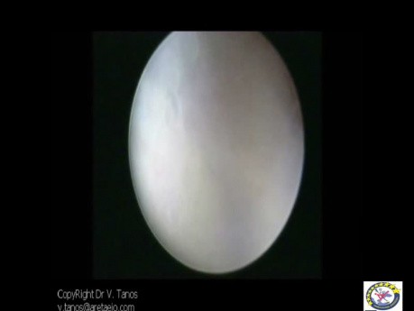 Hysteroscopic Evaluation Suspected Endometritis