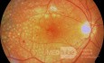 Panretinal Photocoagulation in Proliferative Diabetic Retinopathy