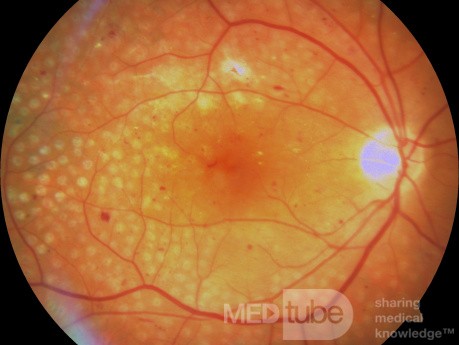 Panretinal Photocoagulation in Proliferative Diabetic Retinopathy