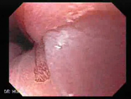 Barrett's Esophagus of long segment -magnifying biopsy (7 of 24)