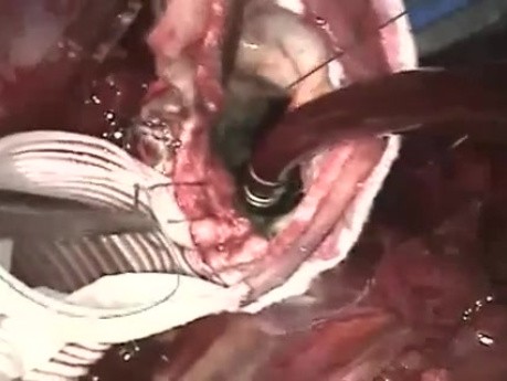 Repair of Aneurysm of the Ascending Aorta 