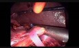 Laparoscopic Pancreatoduodenectomy