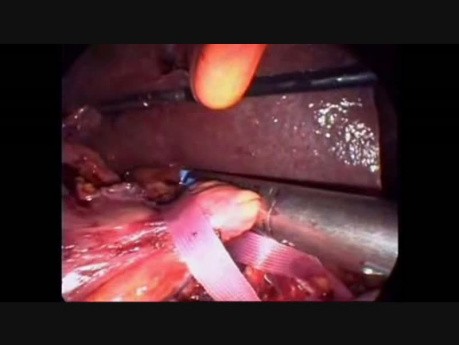 Laparoscopic Pancreatoduodenectomy