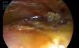 Pioneering Endoscopic Nipple/Skin Sparing Mastectomy in Egypt: Initial Experience after Worldwide Adoption with a Novel Free Dermal Fat Graft Whole Breast Reconstruction