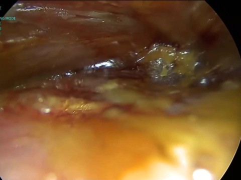 Pioneering Endoscopic Nipple/Skin Sparing Mastectomy in Egypt: Initial Experience after Worldwide Adoption with a Novel Free Dermal Fat Graft Whole Breast Reconstruction