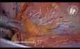 Reduction and Suspension of a Cord Lipoma