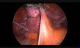 Laparoscopic Bowel Myoma Resection