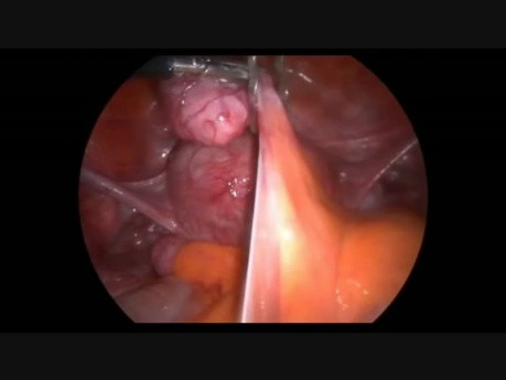 Laparoscopic Bowel Myoma Resection