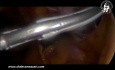 Re-sleeve Gastrectomy