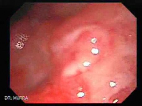 Adenocarcinoma of the Lesser Curvature with Signet Ring Cells (6 of 8)