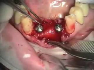 Immediate implantation