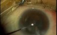 Phacoemulsification - Horizontal Chopping - Brown Case