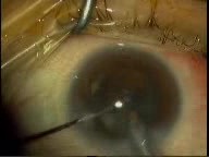 Phacoemulsification - Horizontal Chopping - Brown Case