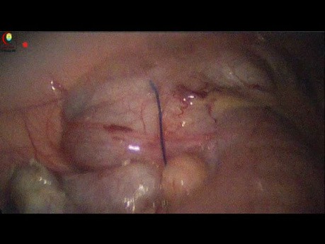 Ileal Flange