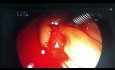 Post Sphincterotomy Bleeding