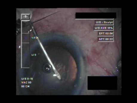 Cataract Surgery XI - Part 1
