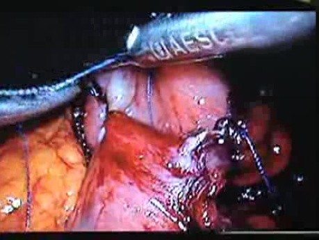 Jejunal Gastrointestinal Stromal tumor (GIST) (51 of 86)
