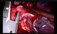 Uniportal Vats Complex Sleeve Bilobectomy With Reconstruction of B1-B2-B3