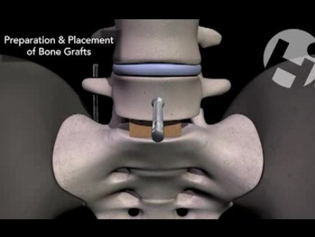 L5-S1 Anterior and Posterior Discectomy and Spinal Fusion