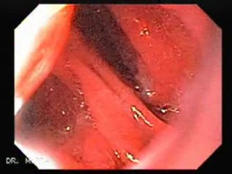 Esophageal Stricture After Total Gastrectomy And Chemoradiation - Inspection Of The Anastomosis - 3/3