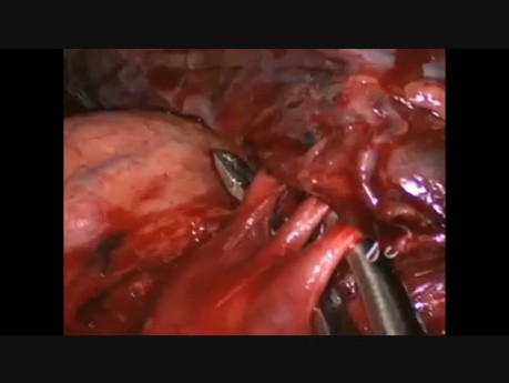 Anatomical Variant of Artery in the Fissure During Single-Port VATS Left Upper Lobectomy