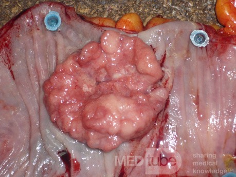 Colon Adenocarcinoma, Villous Adenocarcinoma (9 of 12)