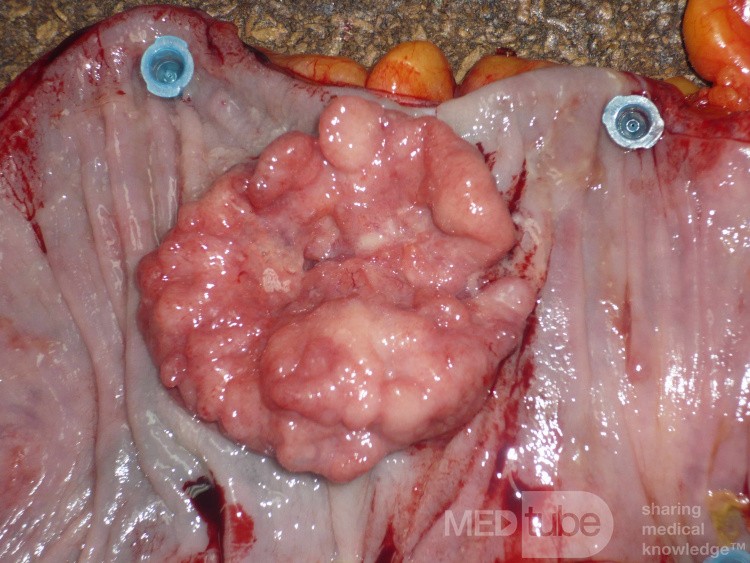 Colon Adenocarcinoma, Villous Adenocarcinoma (9 of 12)