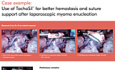 Use of TachoSil® for Sufficient Haemostasis After a Radical Abdominal Hysterectomy (Case Study)