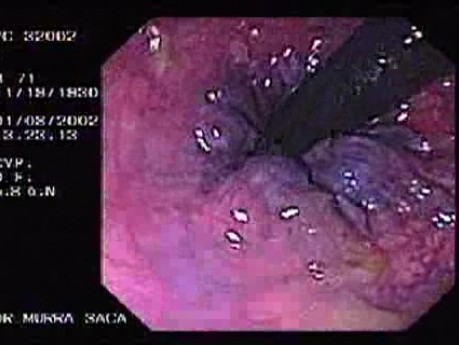 Internal Hemorrhoids.