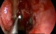 Basic Endoscopic Sinus Surgery