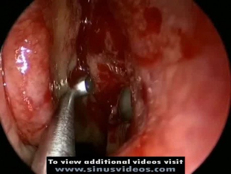 Basic Endoscopic Sinus Surgery
