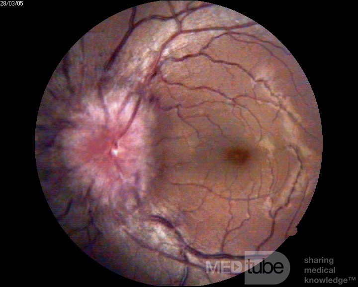 Papilledema