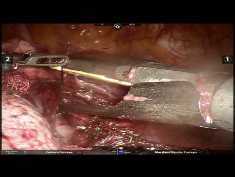 Right Lower Lobectomy with Atypical Bronchoplasty