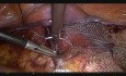 Mesh Transversal Suspension for Symptomatic Cystocele
