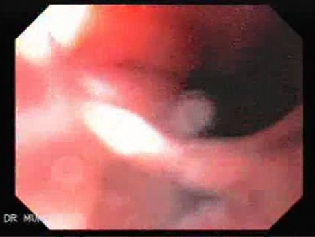 Esophageal Papilloma of the Lower Third  - Part 3