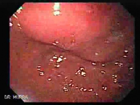 Hyperplastic Polyps - Endoscopy (9 of 14)