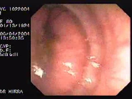 Sessile Villous Adenoma (2 of 3)