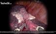Use of TachoSil® in Robotic Thoracic Surgery, Covering Different Cases and Indications Including Hemostasis, Aerosealing, and Lymphsealing, Presented by Prof. Baste