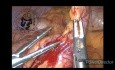 Lap Appendectomy in Acute Appendicitis
