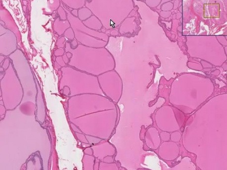 Colloid goiter - Histopathology of thyroid