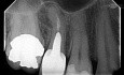 Surgery in Endodontics Under the Micro