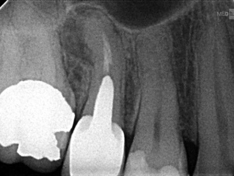 Surgery in Endodontics Under the Micro