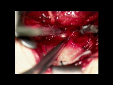Foreign Material Removal from the Lumbar Spine