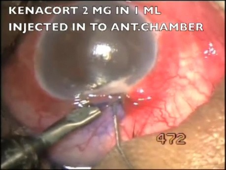 Microtrack filtration of uveitic glaucoma