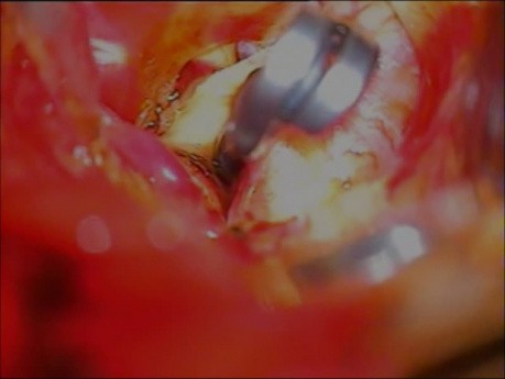 Brain Aneurysm - Posterior Communicating Aretry Aneurysm - Microsurgery