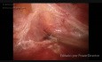 Isthmocele Correction