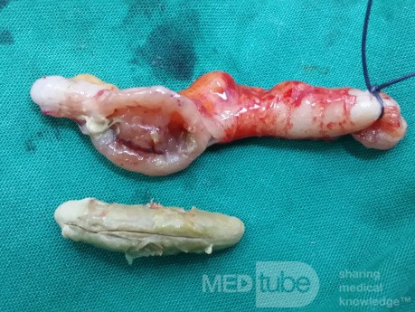 Obstructive Acute Appendicitis